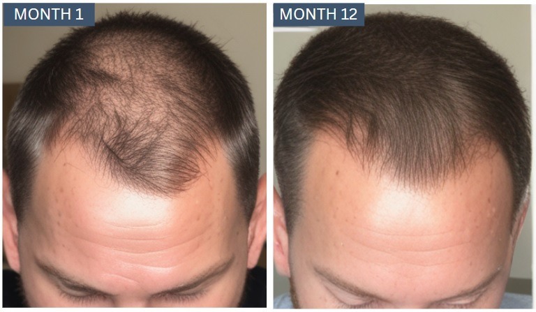 hair growth men before and after 